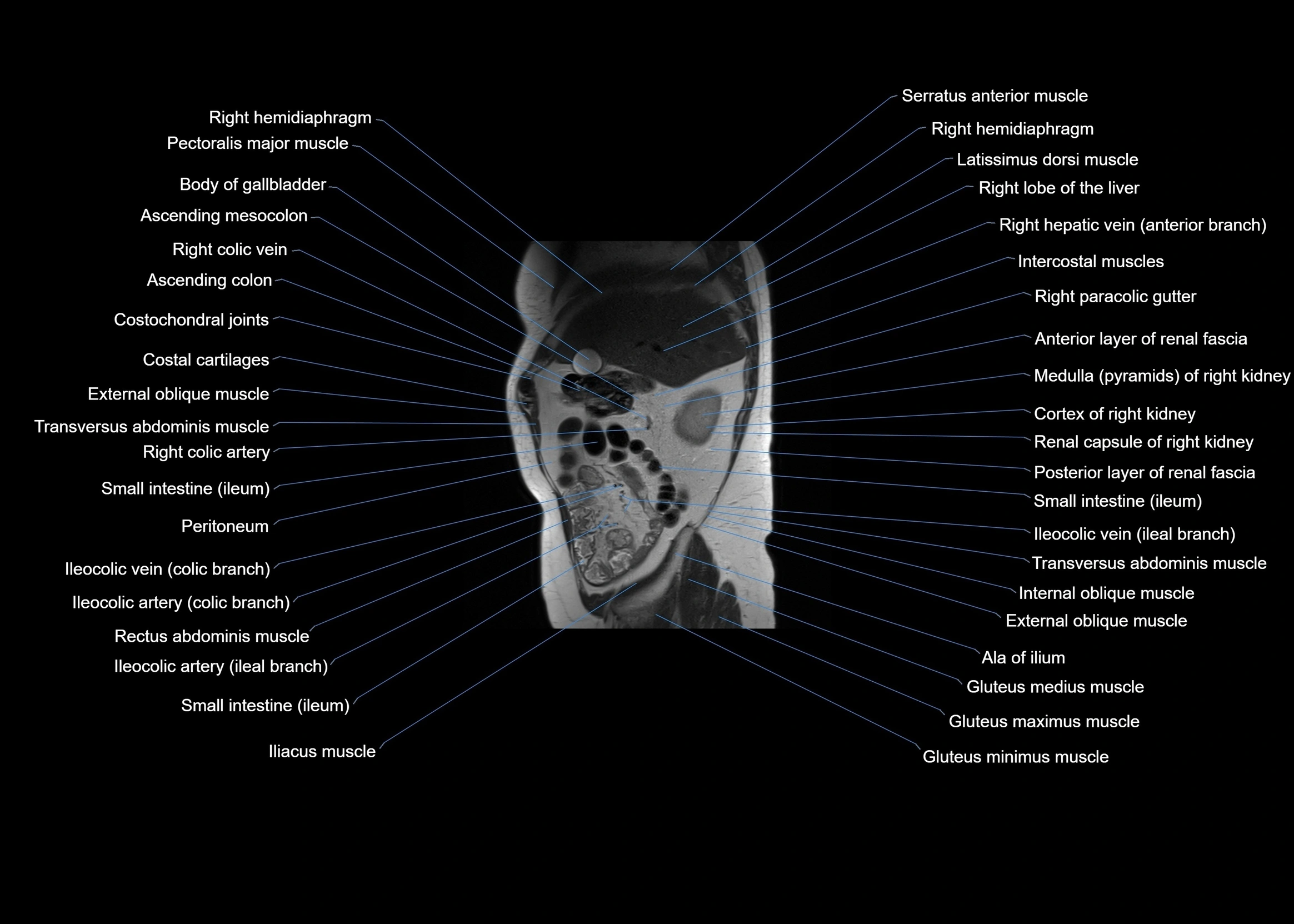 MRI abdomen sagittal cross sectional anatomy  radiology  image-img-00001-00017.webp